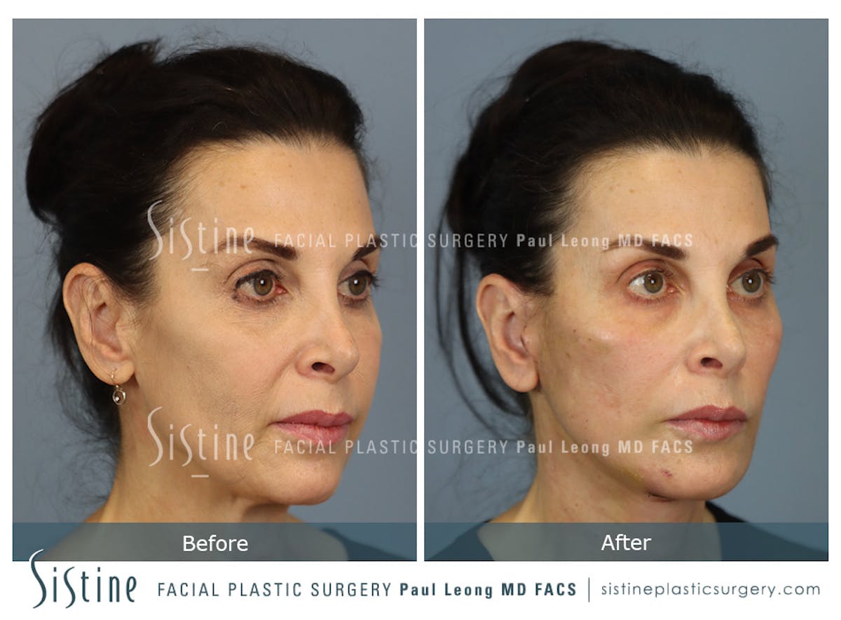 Deep Neck Lift Before & After Gallery - Patient 579785 - Image 2