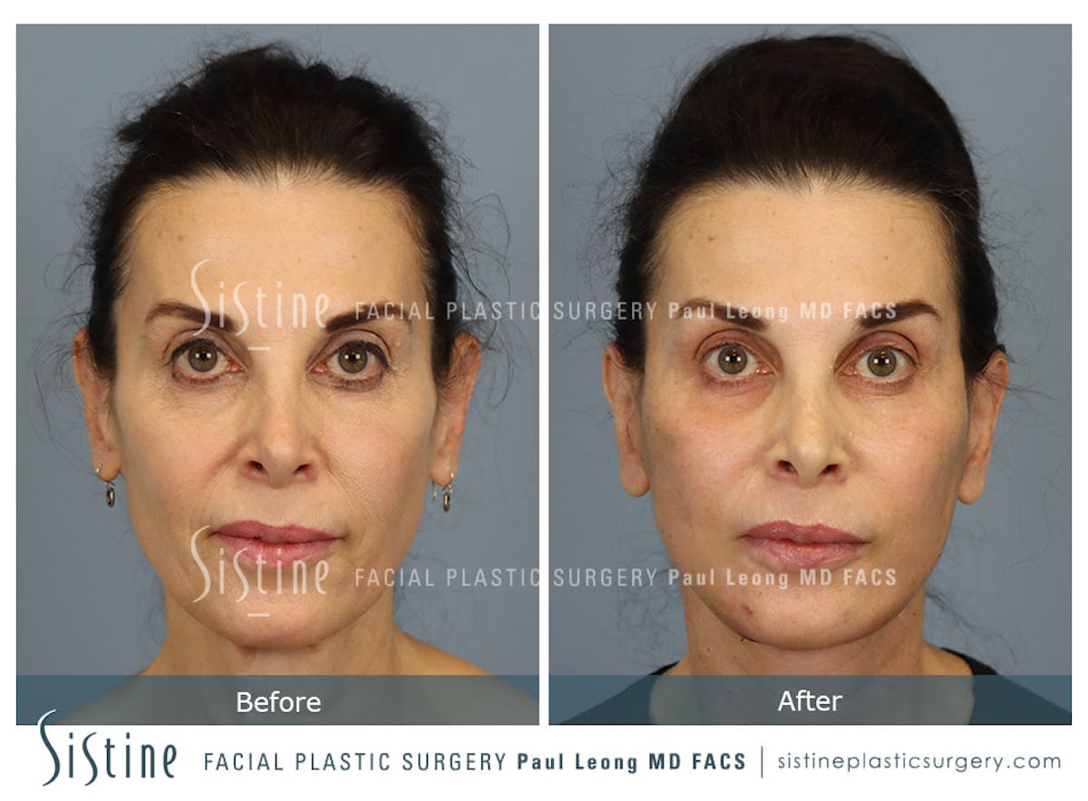 Deep Neck Lift Before & After Gallery - Patient 579785 - Image 3
