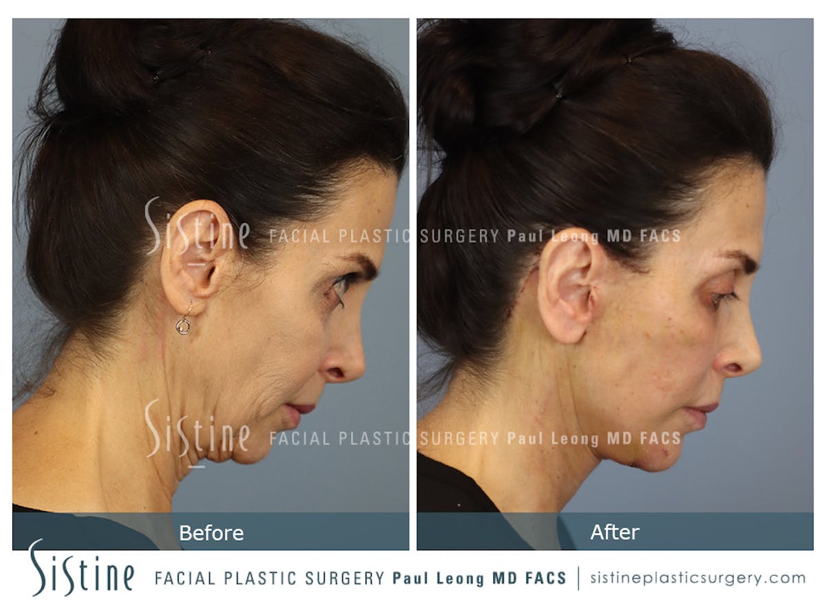 Deep Neck Lift Before & After Gallery - Patient 579785 - Image 4