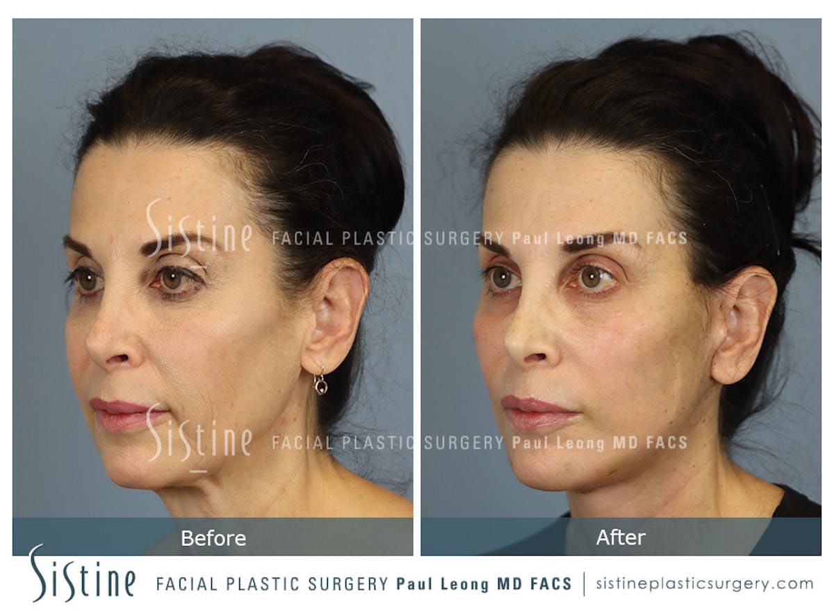 Deep Neck Lift Before & After Gallery - Patient 579785 - Image 5