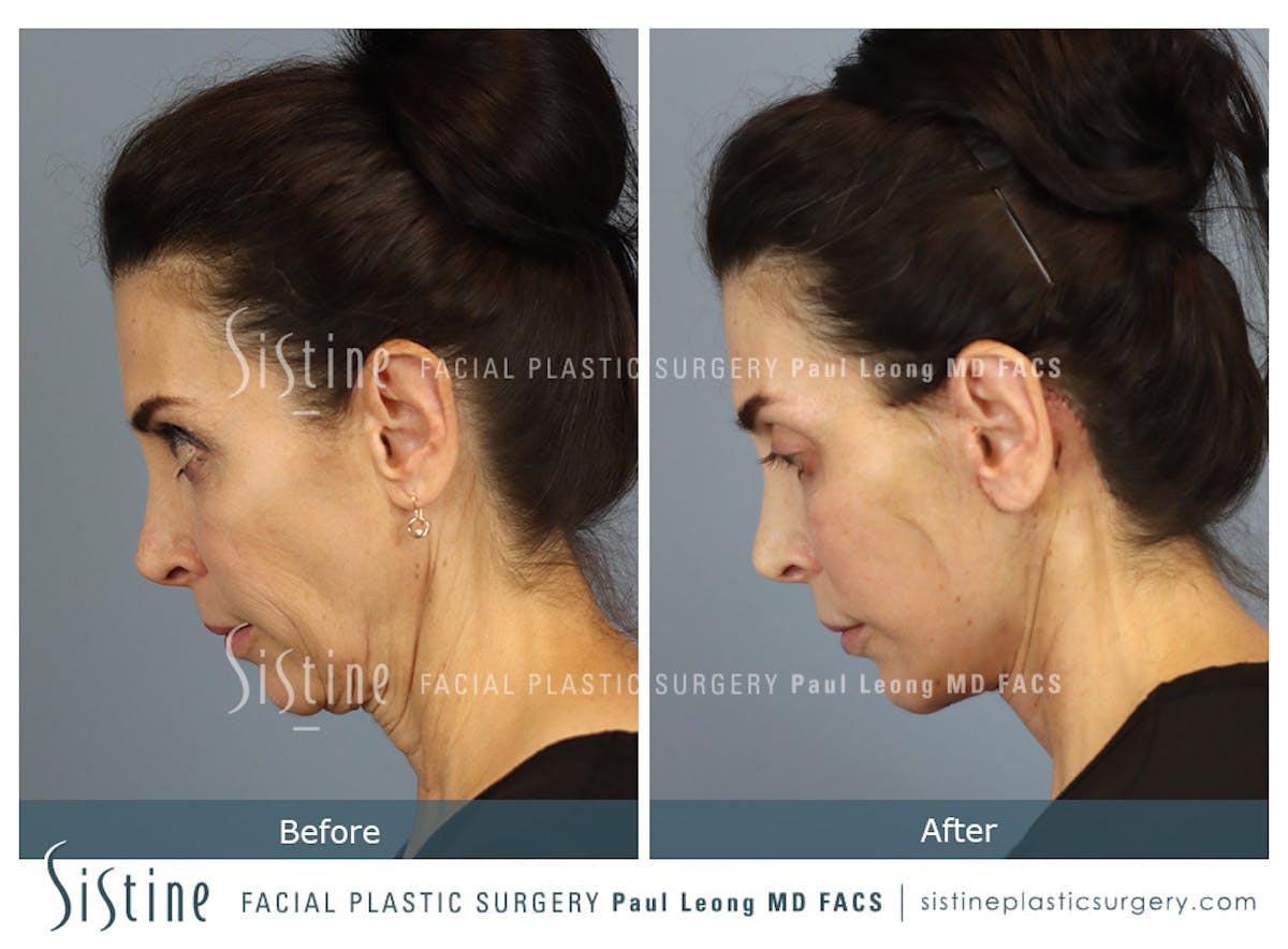 Deep Neck Lift Before & After Gallery - Patient 579785 - Image 7