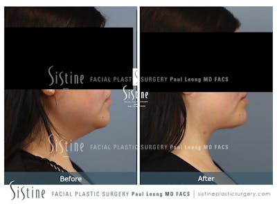 Deep Neck Lift Before & After Gallery - Patient 772302 - Image 1