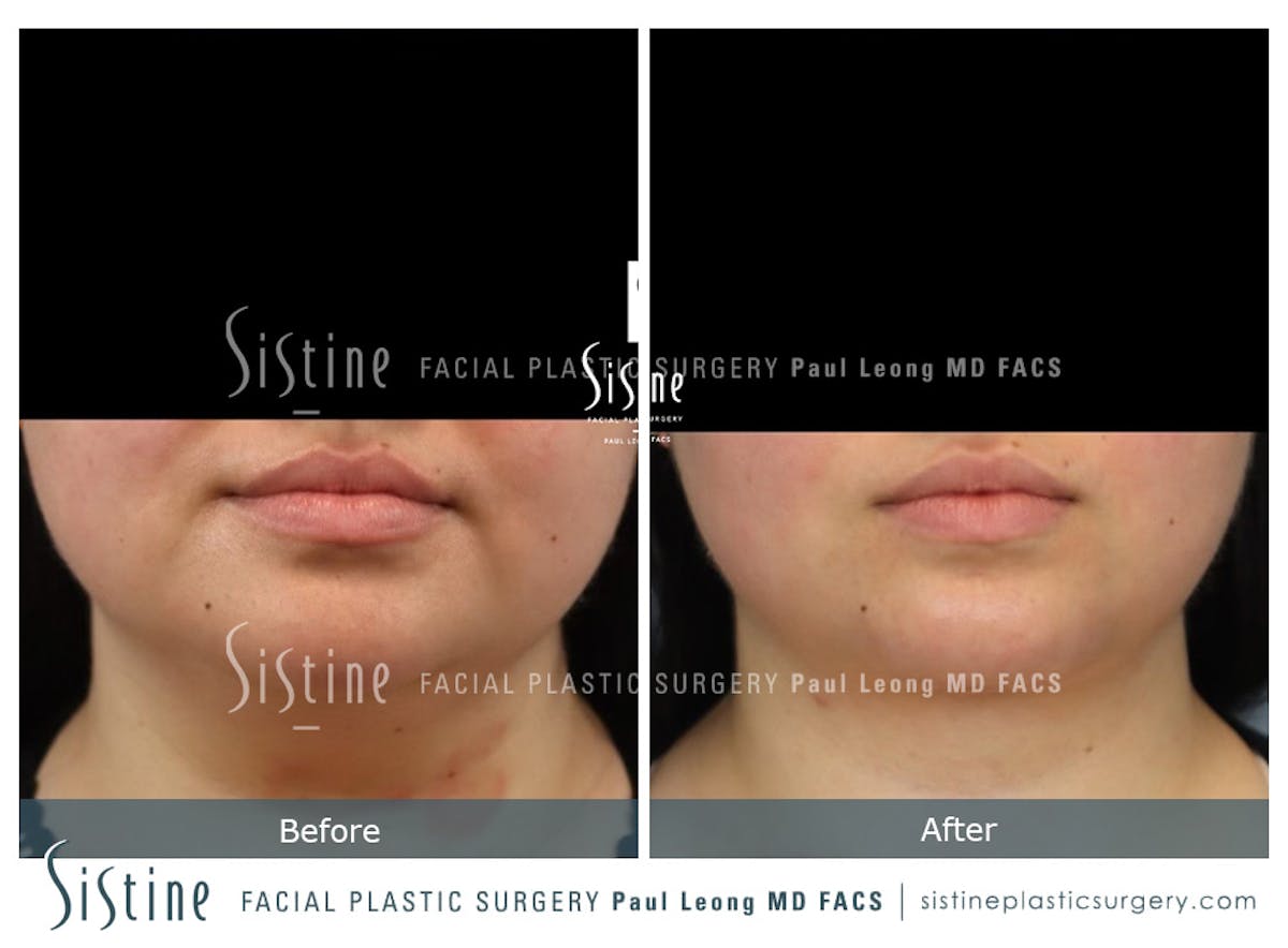 Deep Neck Lift Before & After Gallery - Patient 772302 - Image 2