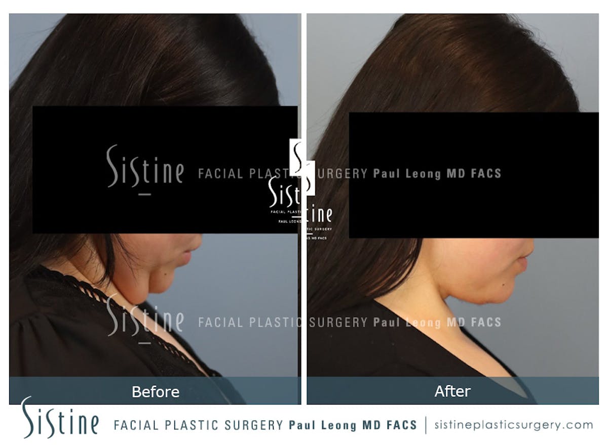Deep Neck Lift Before & After Gallery - Patient 772302 - Image 3