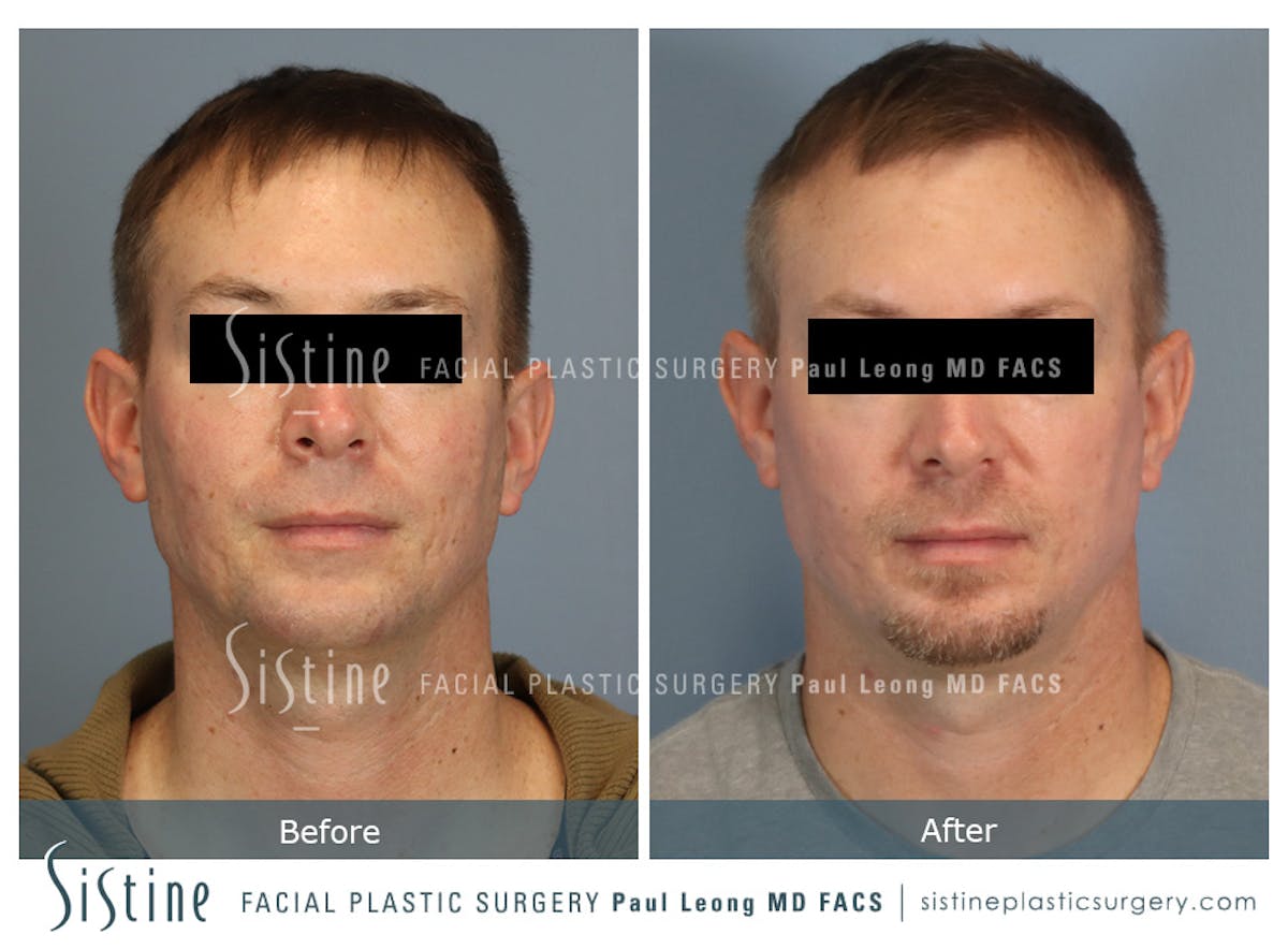 Phoenix CO2 Before & After Gallery - Patient 207541 - Image 1