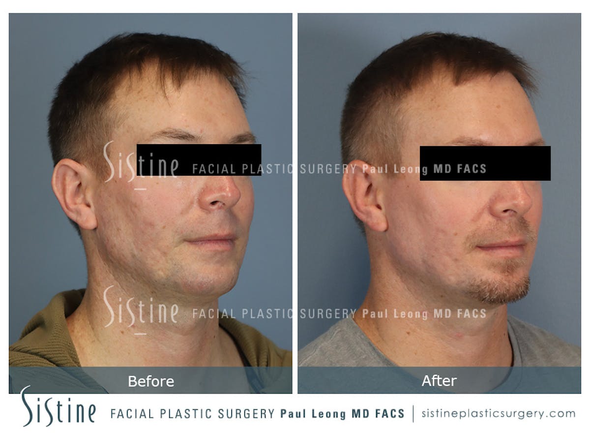 Phoenix CO2 Before & After Gallery - Patient 207541 - Image 2