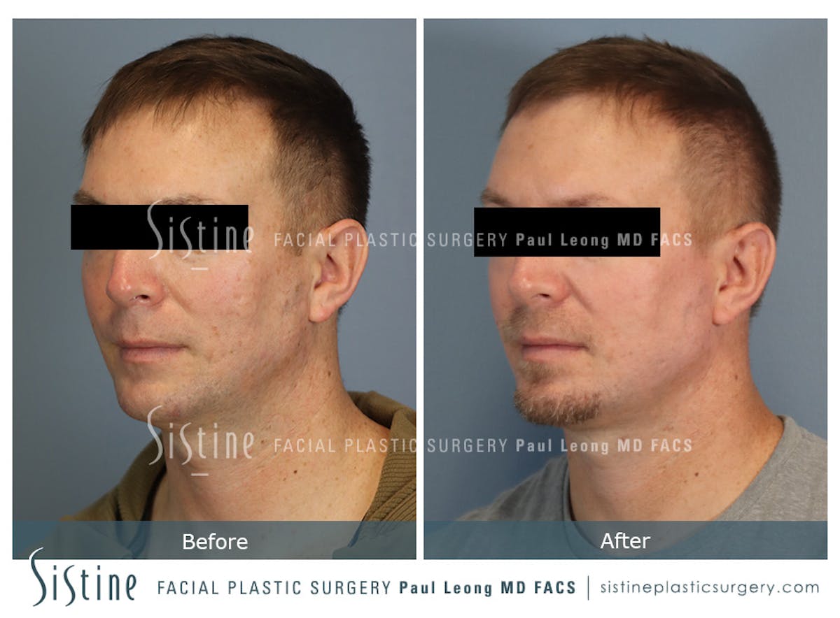 Phoenix CO2 Before & After Gallery - Patient 207541 - Image 3