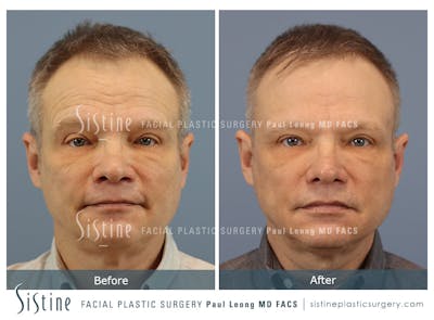 Phoenix CO2 Before & After Gallery - Patient 338902 - Image 1