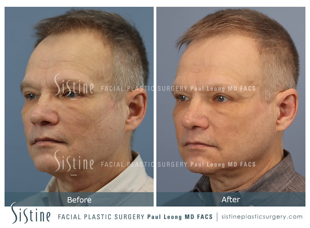 Phoenix CO2 Before & After Gallery - Patient 338902 - Image 2