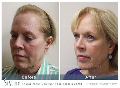 Phoenix CO2 Before & After Gallery - Patient 390290 - Image 1