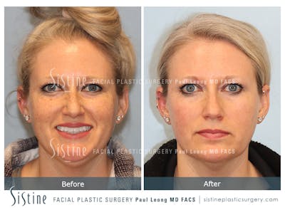 Photofacial Before & After Gallery - Patient 379313 - Image 1