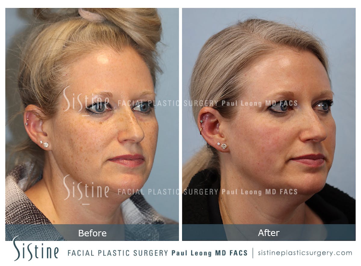 Photofacial Before & After Gallery - Patient 379313 - Image 2