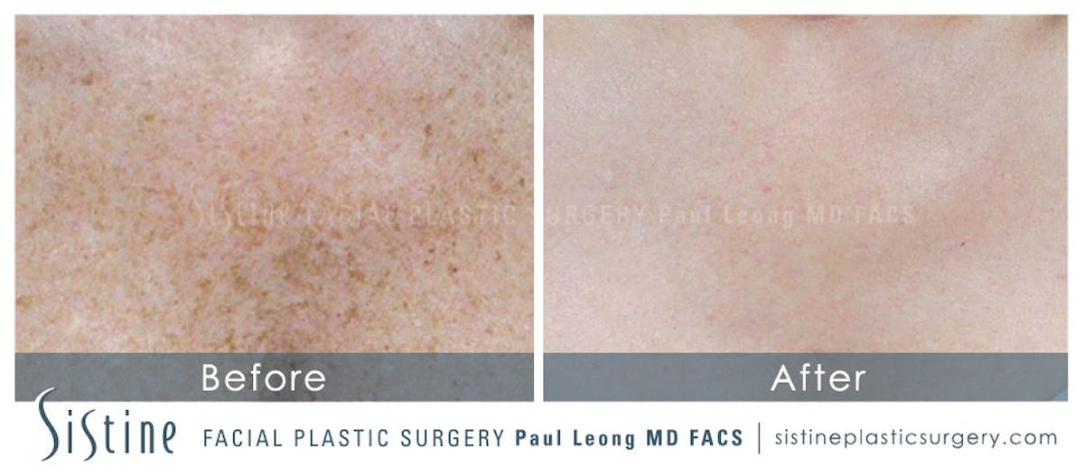 Photofacial Before & After Gallery - Patient 132580 - Image 1