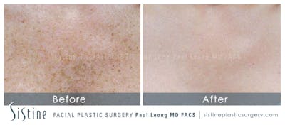 Photofacial Before & After Gallery - Patient 132580 - Image 1