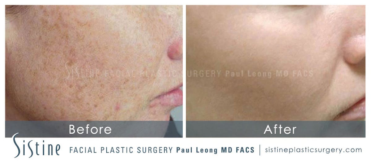Photofacial Before & After Gallery - Patient 319864 - Image 1