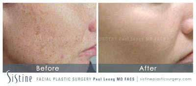 Photofacial Before & After Gallery - Patient 319864 - Image 1