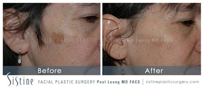Photofacial Before & After Gallery - Patient 237489 - Image 1