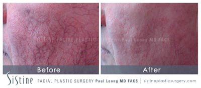 Photofacial Before & After Gallery - Patient 317277 - Image 1