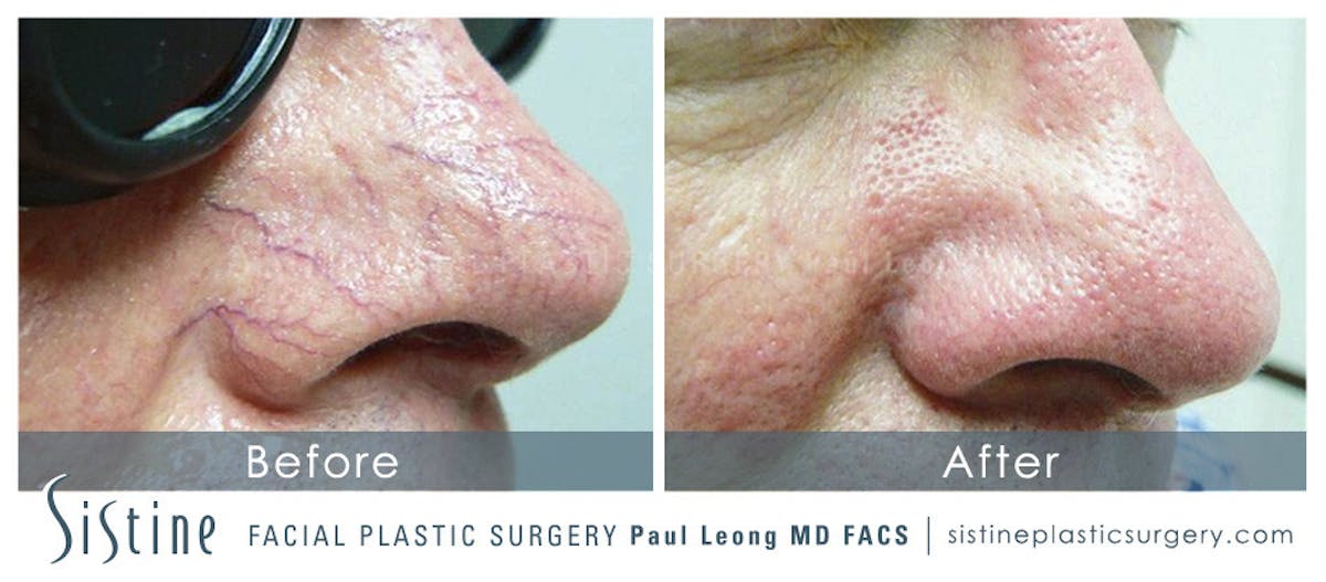 Photofacial Before & After Gallery - Patient 948246 - Image 1