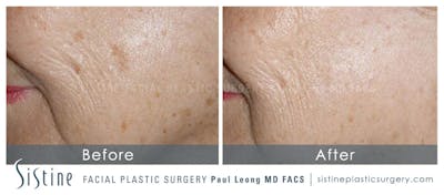 Photofacial Before & After Gallery - Patient 380814 - Image 1