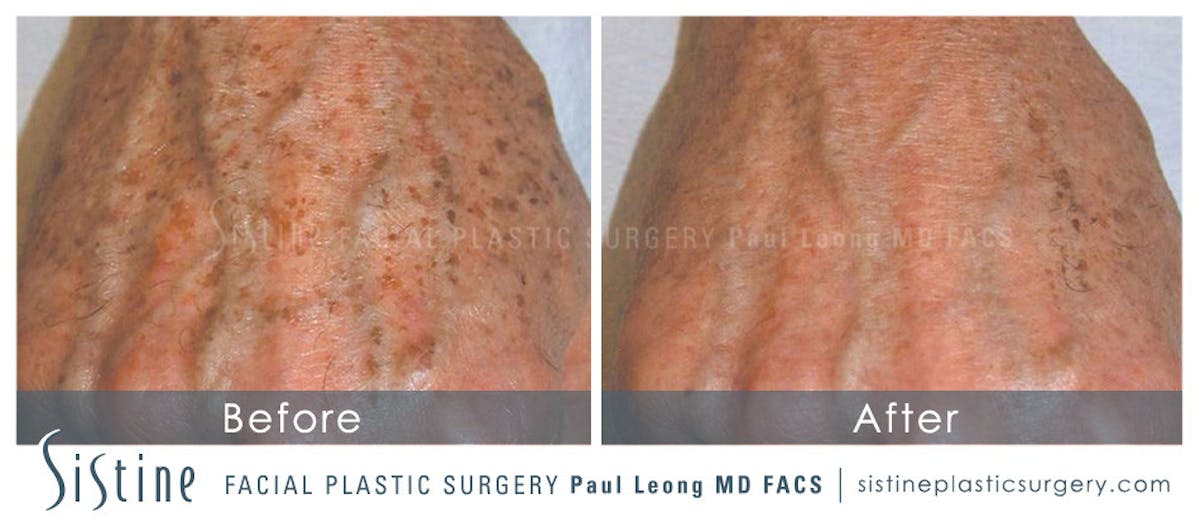 Photofacial Before & After Gallery - Patient 106770 - Image 1