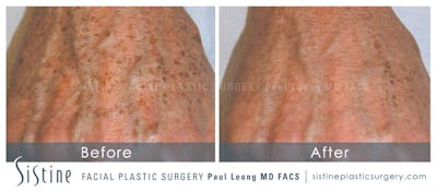 Photofacial Before & After Gallery - Patient 106770 - Image 1
