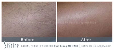 Laser Hair Removal Before & After Gallery - Patient 564351 - Image 1