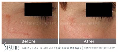 Scar Wrinkle Removal Before & After Gallery - Patient 175424 - Image 1