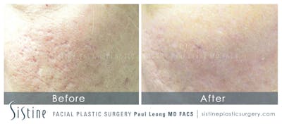 Scar Wrinkle Removal Before & After Gallery - Patient 216892 - Image 1