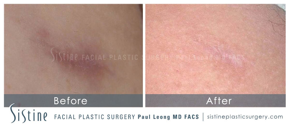 Scar Wrinkle Removal Before & After Gallery - Patient 215145 - Image 1