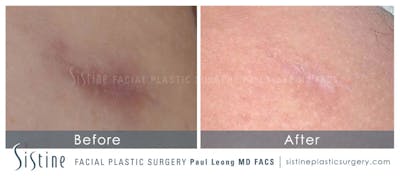Scar Wrinkle Removal Before & After Gallery - Patient 215145 - Image 1