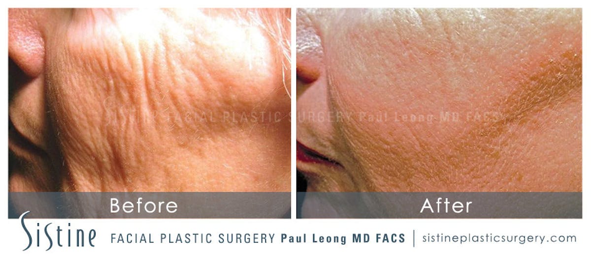 Scar Wrinkle Removal Before & After Gallery - Patient 225027 - Image 1