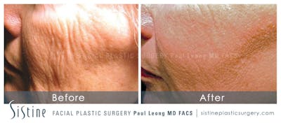 Scar Wrinkle Removal Before & After Gallery - Patient 225027 - Image 1
