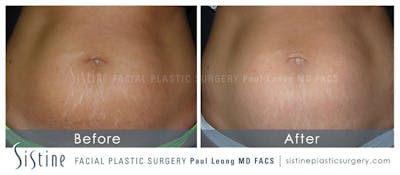 Stretch Marks Before & After Gallery - Patient 265766 - Image 1
