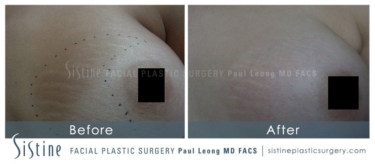 Stretch Marks Before & After Gallery - Patient 233437 - Image 1