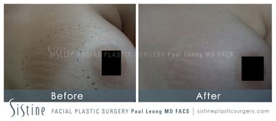 Stretch Marks Before & After Gallery - Patient 233437 - Image 1