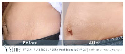 Stretch Marks Before & After Gallery - Patient 193464 - Image 1