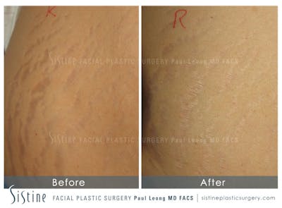 Stretch Marks Before & After Gallery - Patient 968837 - Image 1