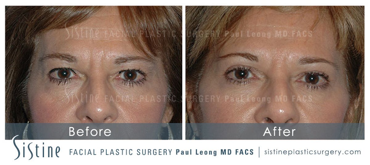 Ultherapy Before & After Gallery - Patient 386348 - Image 1