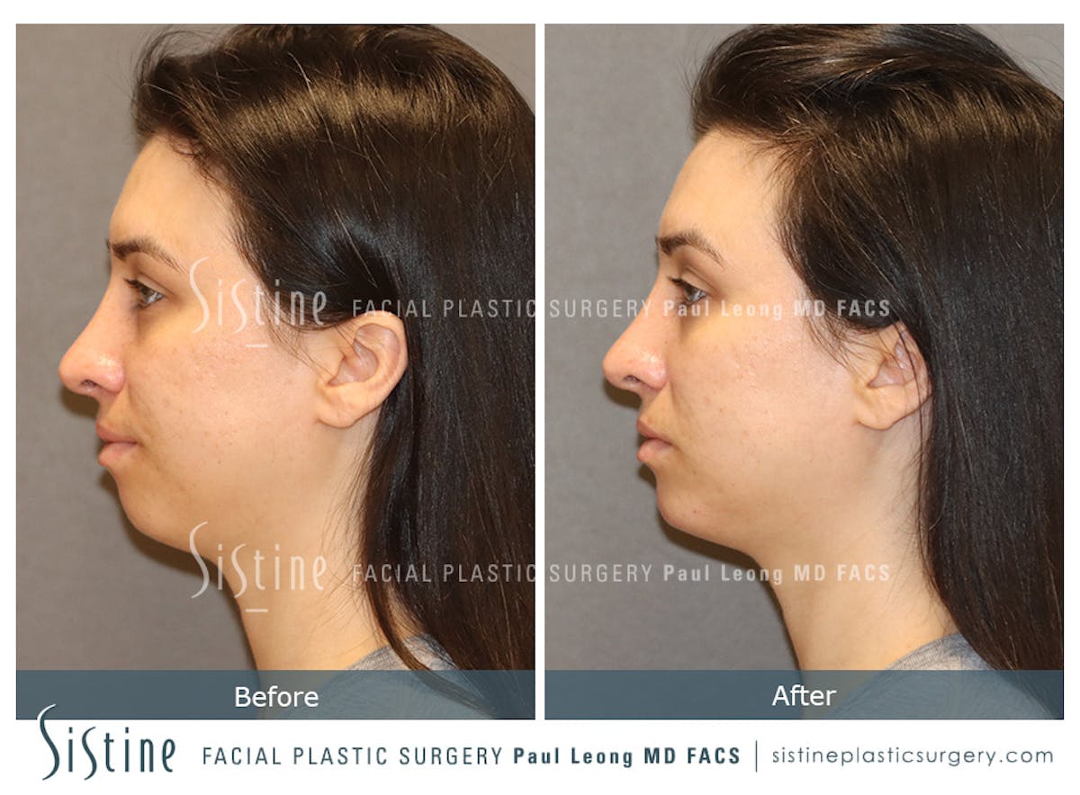 Chin Jaw And Neck Before & After Gallery - Patient 273410 - Image 2