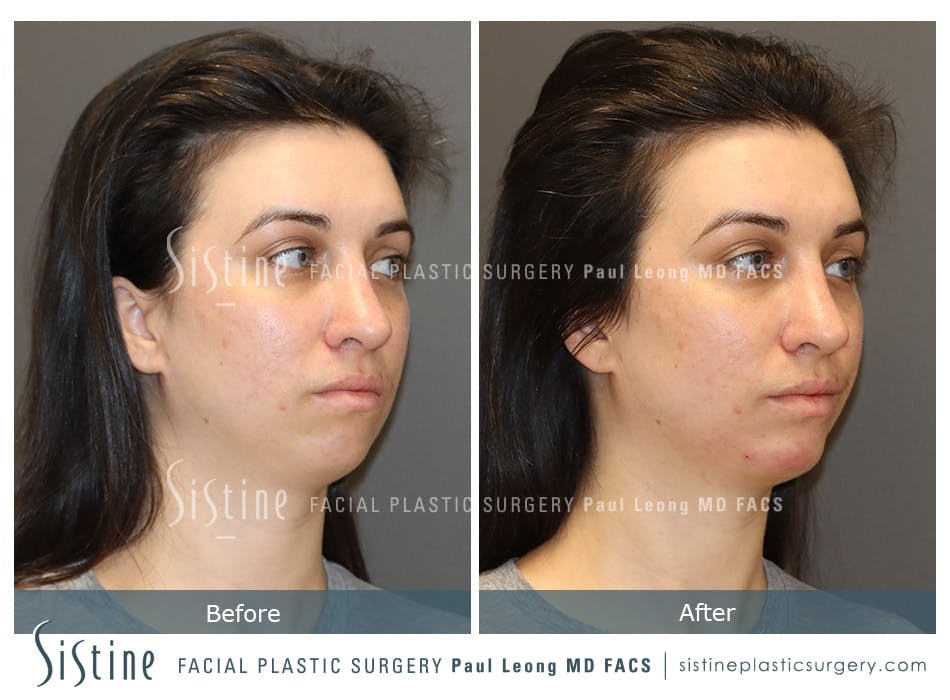 Chin Jaw And Neck Before & After Gallery - Patient 273410 - Image 3