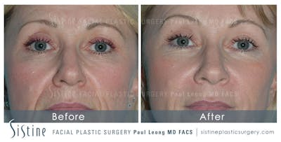 Nasolabial Folds Before & After Gallery - Patient 308403 - Image 1