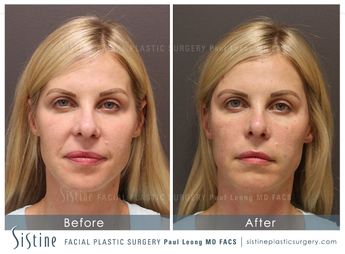 Temples Before & After Gallery - Patient 234804 - Image 1