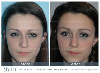 Nose Before & After Gallery - Patient 286593 - Image 1