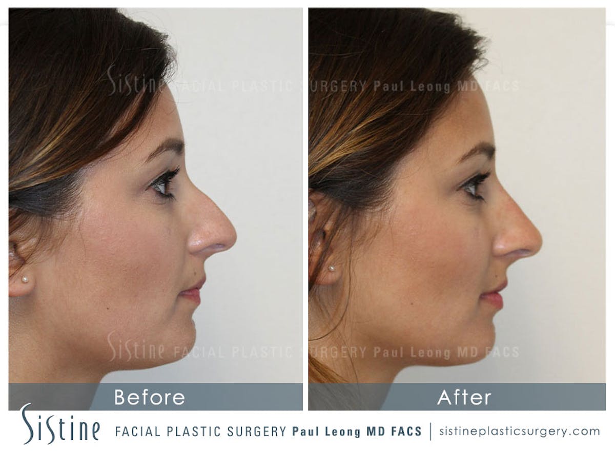 Nose Before & After Gallery - Patient 395543 - Image 1