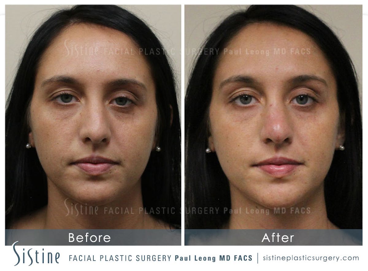 Nose Before & After Gallery - Patient 150714 - Image 1