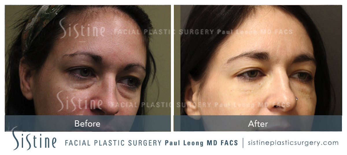 Eyes Before & After Gallery - Patient 362852 - Image 1