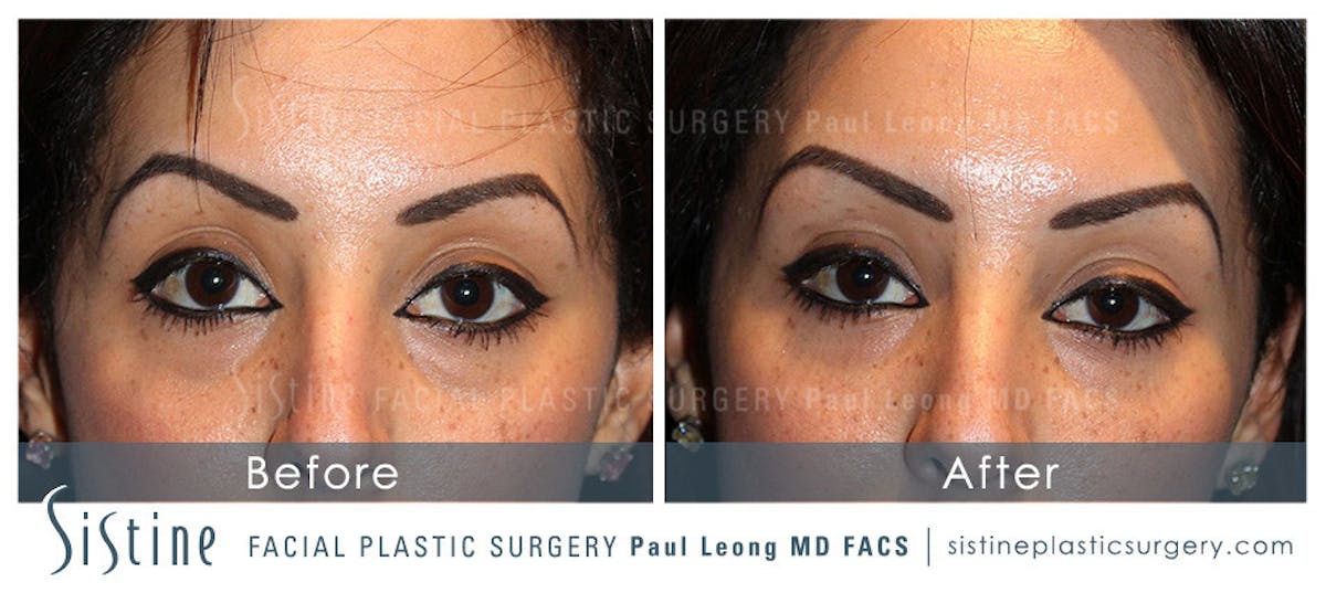 Eyes Before & After Gallery - Patient 363389 - Image 1