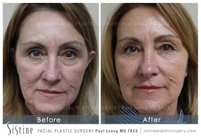 Cheeks Before & After Gallery - Patient 124353 - Image 1