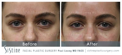 Eyes Before & After Gallery - Patient 216647 - Image 1